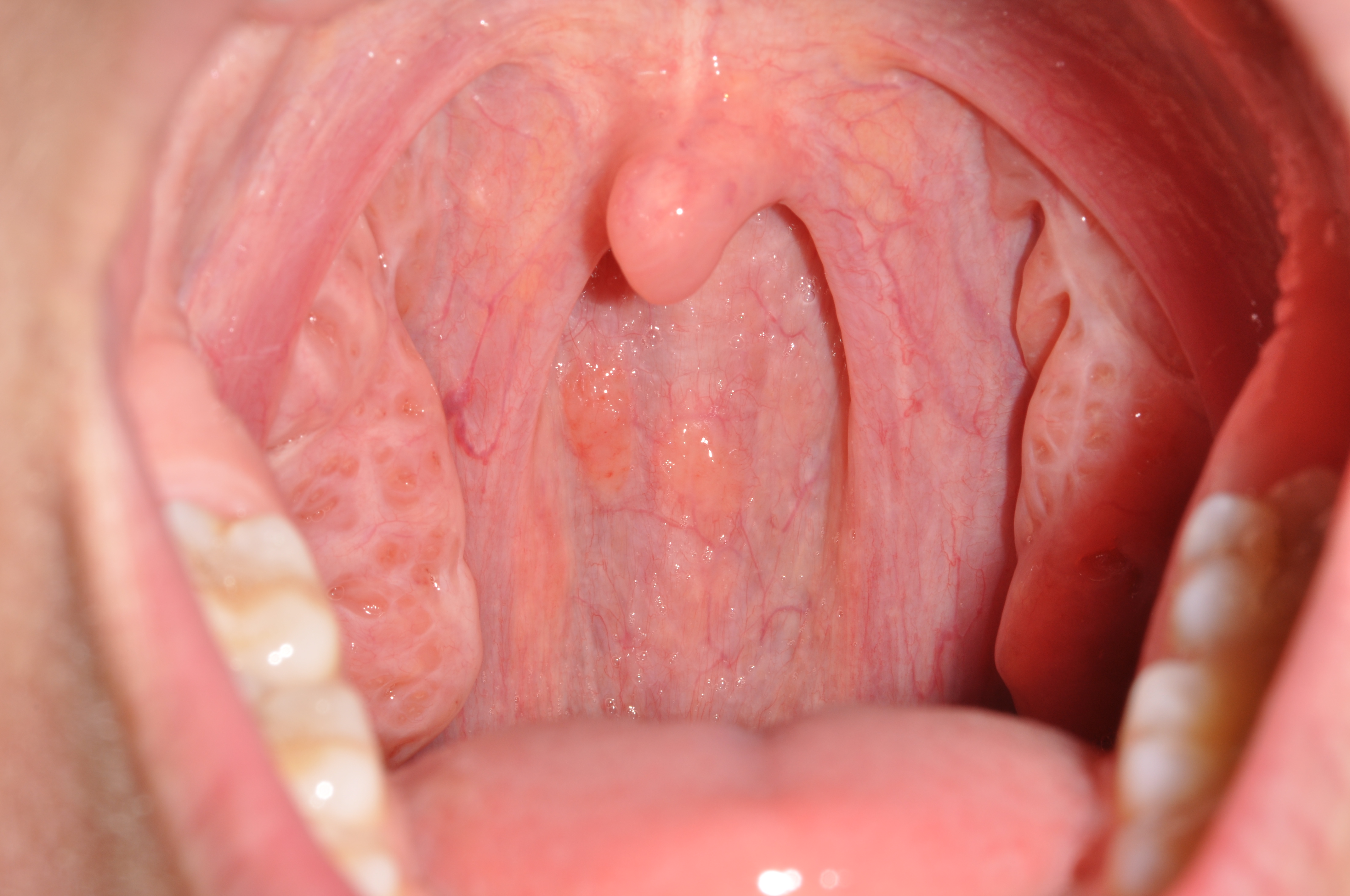 What Does Cancer In Throat Look Like Oral Cancer Screening Brook 